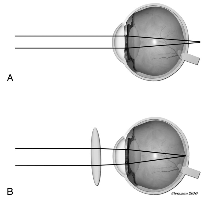 Figure 6 of 3rd Edition - Understanding and Managing Visual Deficits